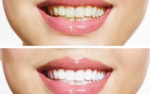 dişler neden sararır diş beyazlatma nedir